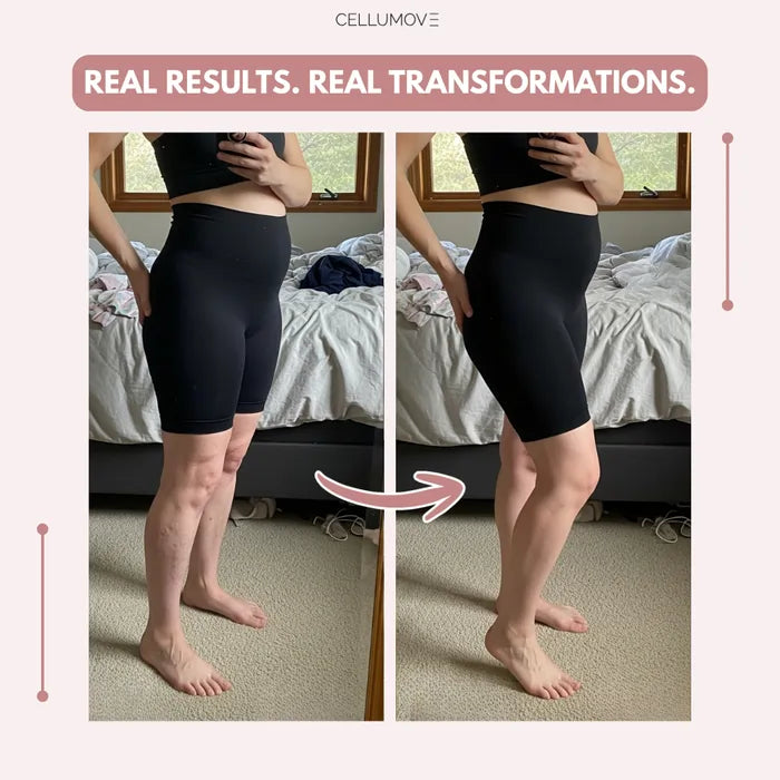 Cellumove USA 3D Legging – Post partum Edema