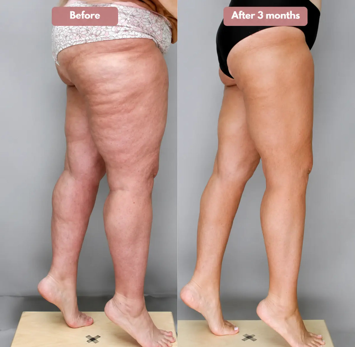 Cellumove USA 3D Legging – Say goodbye to lipoedema pain and swelling naturally.