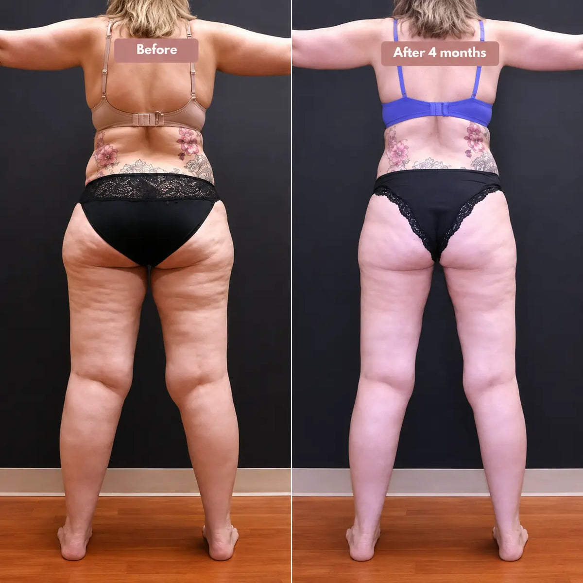 Cellumove USA 3D Legging – Say goodbye to lipoedema pain and swelling naturally