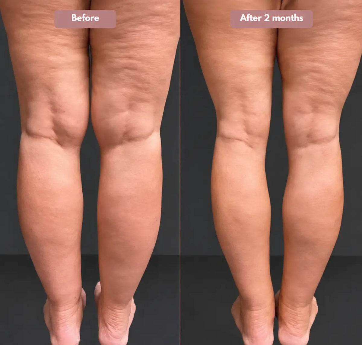 Cellumove USA 3D Legging – Say goodbye to lipoedema pain and swelling naturally.